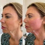 Best Aesthetic Clinics in dubai for Endolift Modern Skin Firming