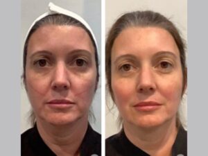 Best Aesthetic Clinic in Dubai for Thread Lift Facial Definition